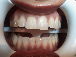 Zahnfarbe natürliche ᐅ Wissenswertes
